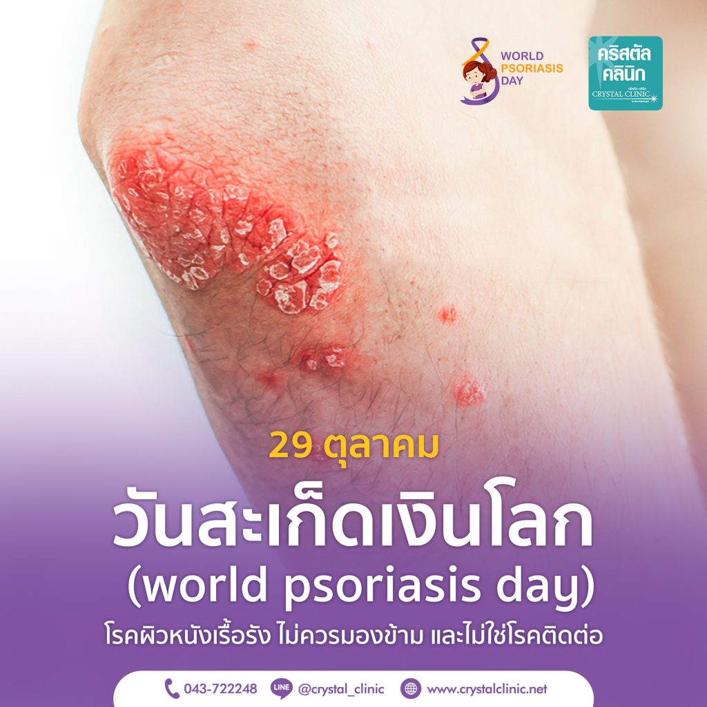 วันสะเก็ดเงินโลก (world psoriasis day)