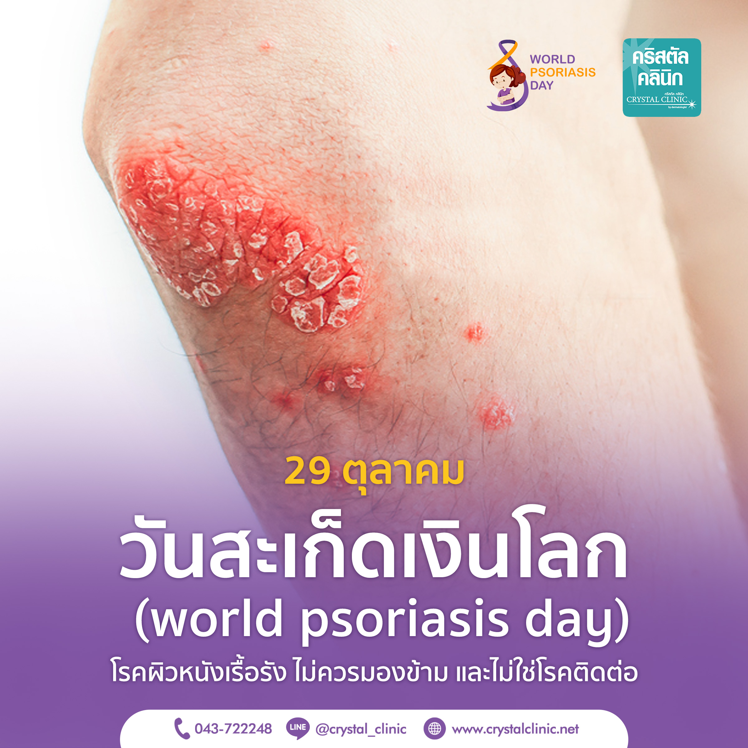 วันสะเก็ดเงินโลก (world psoriasis day)