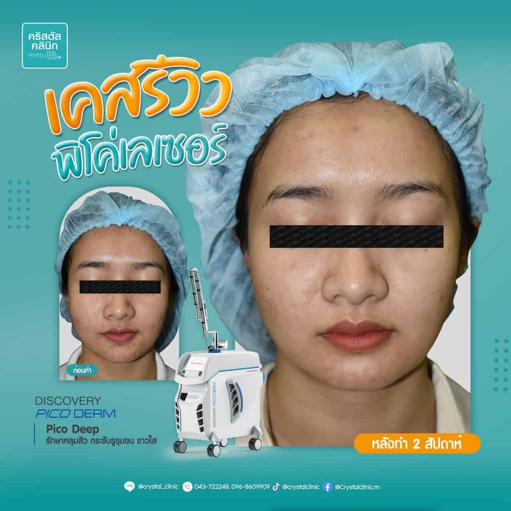 รีวิว Pico Laser คริสตัลคลินิก มหาสารคาม รีวิว Pico Laser คริสตัลคลินิก มหาสารคาม