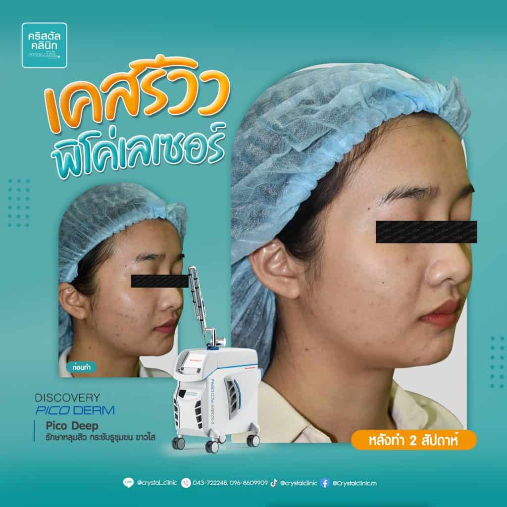 รีวิว Pico Laser คริสตัลคลินิก มหาสารคาม รีวิว Pico Laser คริสตัลคลินิก มหาสารคาม