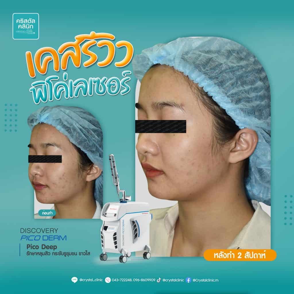 รีวิว Pico Laser คริสตัลคลินิก มหาสารคาม รีวิว Pico Laser คริสตัลคลินิก มหาสารคาม