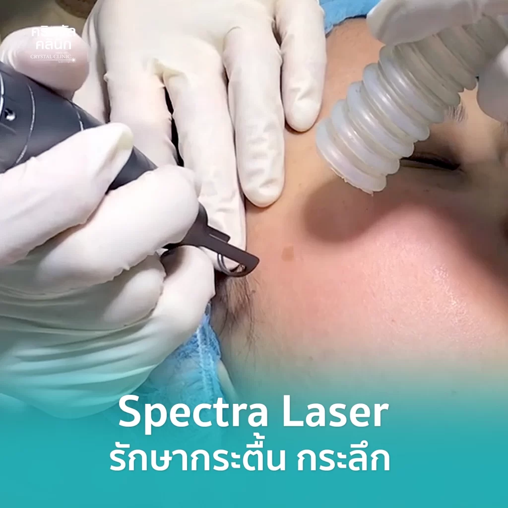 Spectra Laser รักษากระตื้น กระลึก คริสตัลคลินิก มหาสารคาม