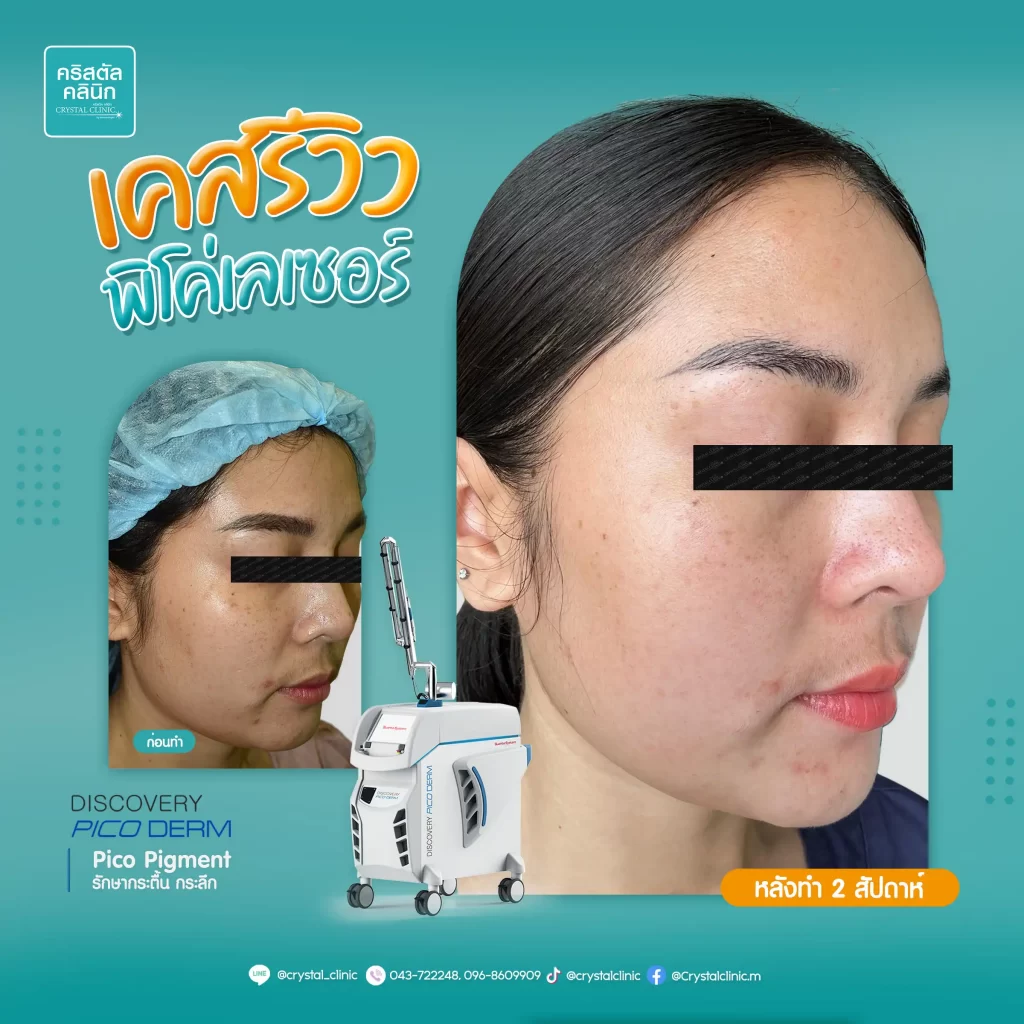 Pico Pigment รักษากระตื้น กระลึก Pico Pigment รักษากระตื้น กระลึก