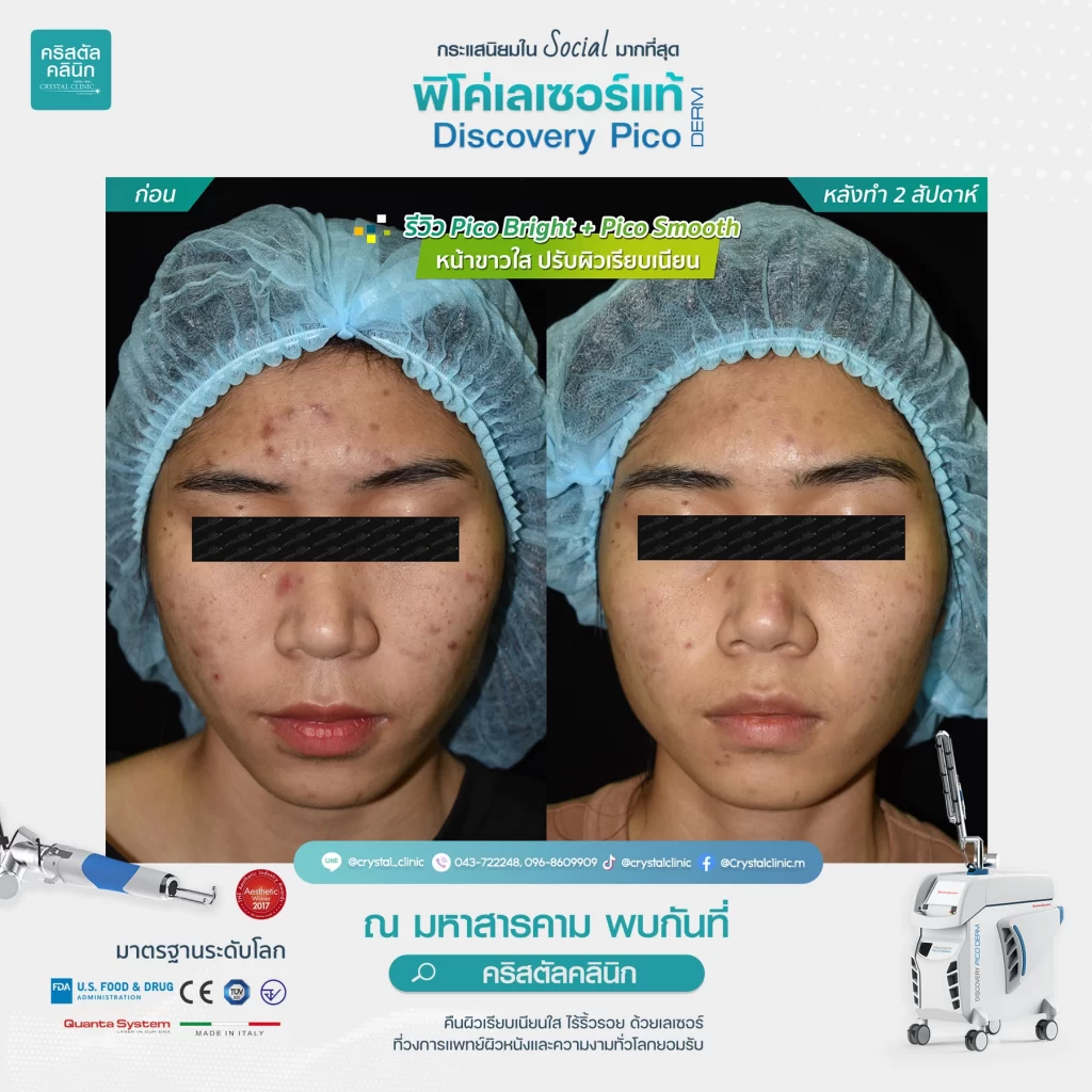 รีวิว Discovery Pico Laser Pico Bright Pico Smooth 1 รีวิว Discovery Pico Laser Pico Bright Pico Smooth 1