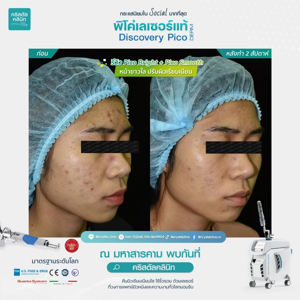 รีวิว Discovery Pico Laser Pico Bright Pico Smooth 2 รีวิว Discovery Pico Laser Pico Bright Pico Smooth 2