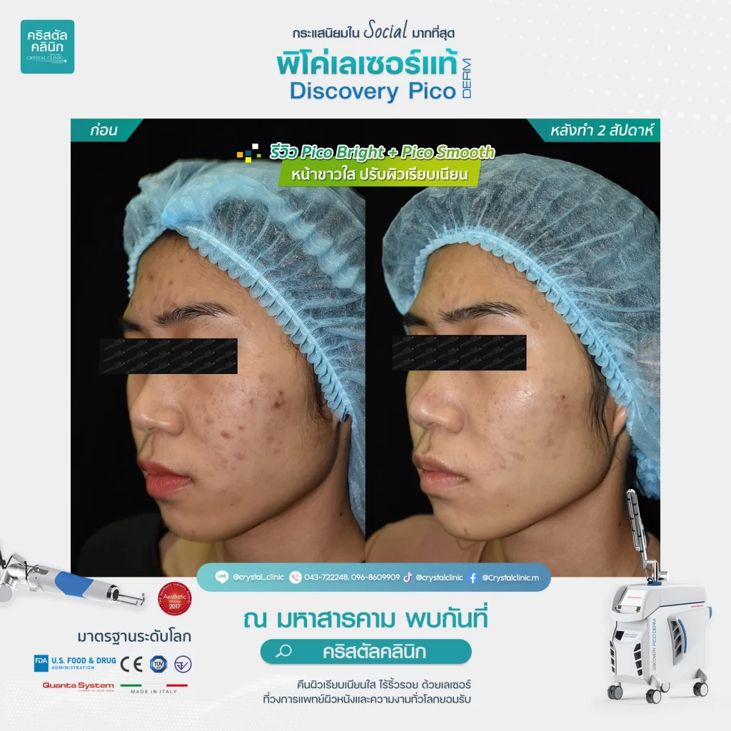 รีวิว Discovery Pico Laser Pico Bright Pico Smooth 3 รีวิว Discovery Pico Laser Pico Bright Pico Smooth 3