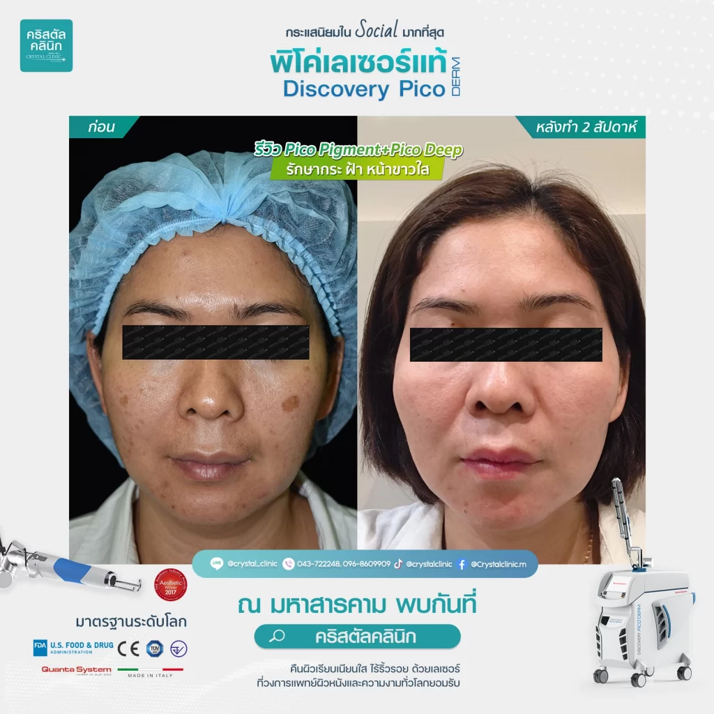 รีวิว Pico Pigment+Deep รักษากระ ฝ้า หน้าขาวใส 01 รีวิว Pico Pigment+Deep รักษากระ ฝ้า หน้าขาวใส 01