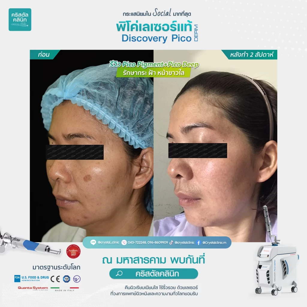 รีวิว Pico Pigment+Deep รักษากระ ฝ้า หน้าขาวใส 02 รีวิว Pico Pigment+Deep รักษากระ ฝ้า หน้าขาวใส 02