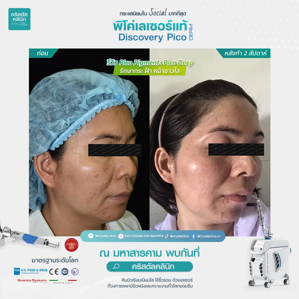 รีวิว Pico Pigment+Deep รักษากระ ฝ้า หน้าขาวใส 03 รีวิว Pico Pigment+Deep รักษากระ ฝ้า หน้าขาวใส 03