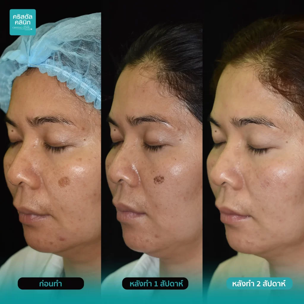 รีวิวรักษากระตื้นกระลึก Discovery Pico Laser Pico Pigment รีวิวรักษากระตื้นกระลึก Discovery Pico Laser Pico Pigment