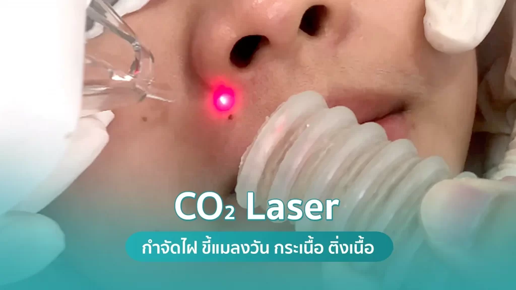 เลเซอร์กำจัดไฝ จี้ไฝ กำจัดขี้แมลงวัน กระ กระเนื้อ หูด ด้วย CO2 Laser โดยคริสตัลคลินิก มหาสารคาม CO2 Laser กำจัดไฝ ขี้แมลงวัน กระเนื้อ ติ่งเนื้อ