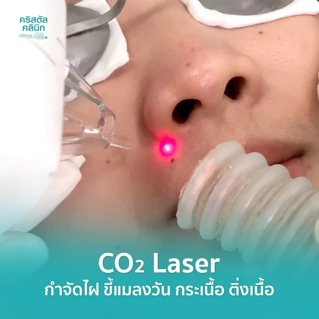 CO2 Laser กำจัดไฝ ขี้แมลงวัน กระเนื้อ ติ่งเนื้อ