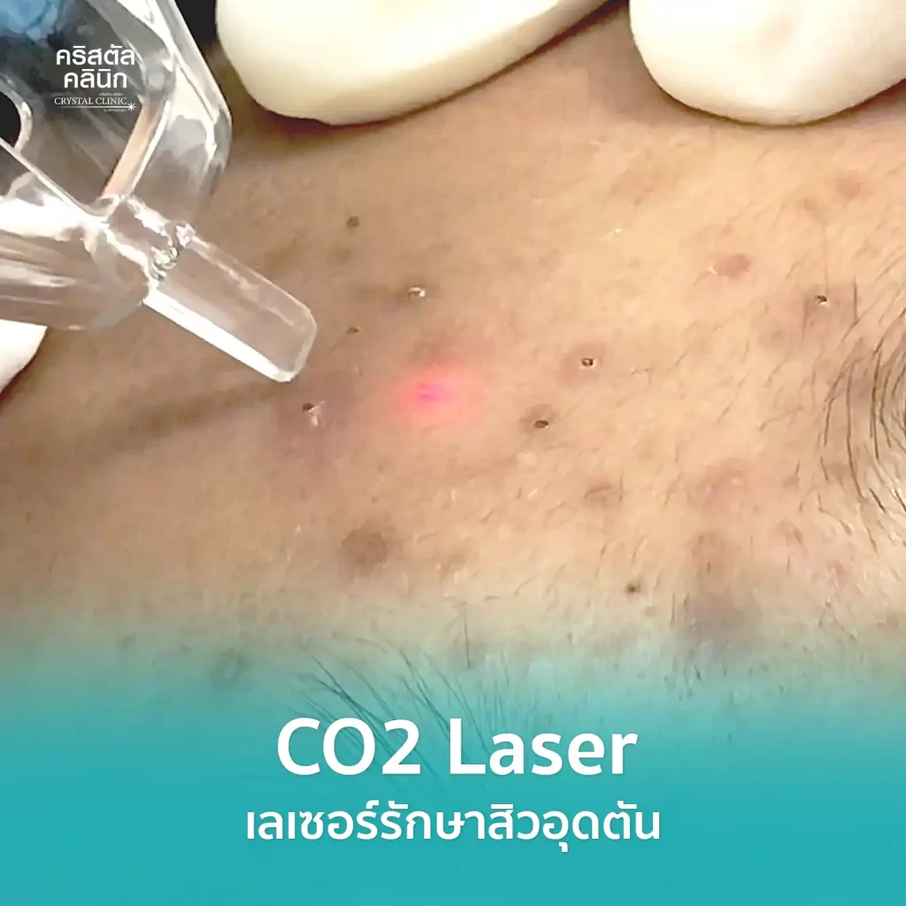 CO2 Laser รักษาสิวอุดตันด้วยเลเซอร์ คริสตัลคลินิก