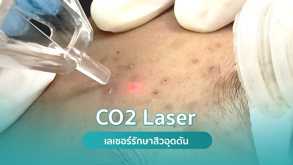 CO2 Laser รักษาสิวอุดตันด้วยเลเซอร์ คริสตัลคลินิก CO2 Laser รักษาสิวอุดตันด้วยเลเซอร์ คริสตัลคลินิก