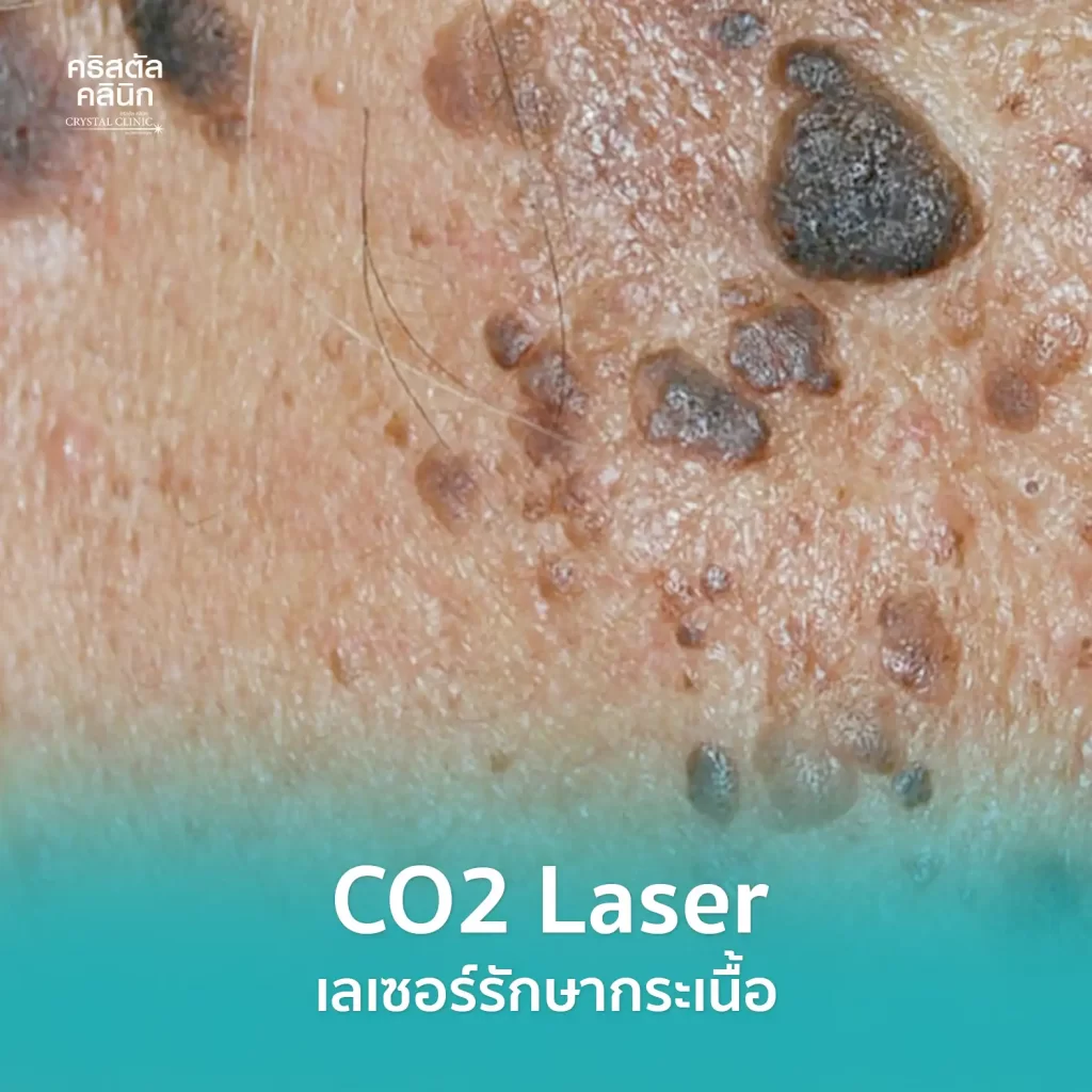 CO2 Laser เลเซอร์รักษากระเนื้อ คริสตัลคลินิก มหาสารคาม