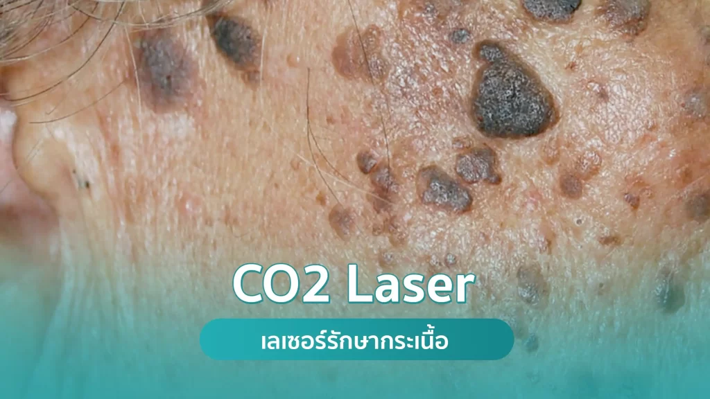 CO2 Laser รักษากระเนื้อ คริสตัลคลินิก มหาสารคาม CO2 Laser เลเซอร์รักษากระเนื้อ คริสตัลคลินิก มหาสารคาม