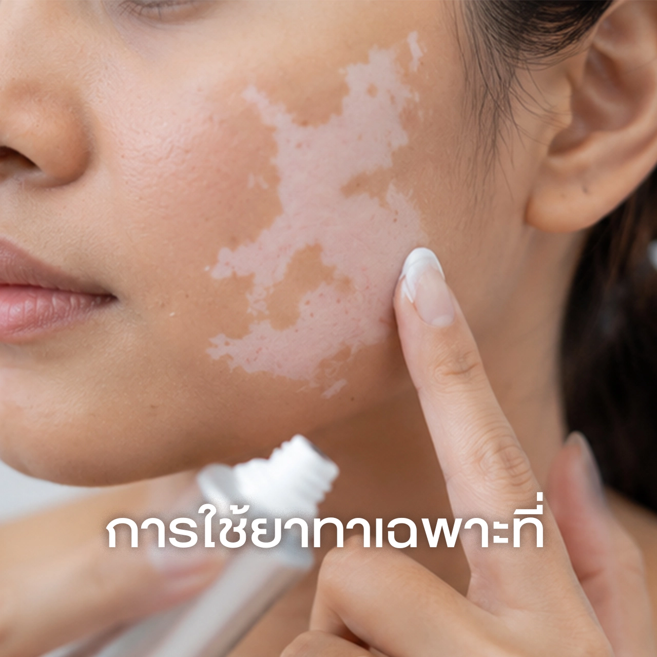 ด่างขาว-การใช้ยาทาเฉพาะที่-Topical-Treatments