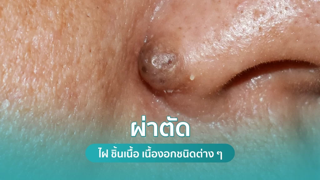 ผ่าตัดไฝ ชิ้นเนื้อ เนื้องอกชนิดต่าง ๆ คริสตัลคลินิก มหาสารคาม ผ่าตัดไฝ ชิ้นเนื้อ เนื้องอกชนิดต่าง ๆ คริสตัลคลินิก มหาสารคาม
