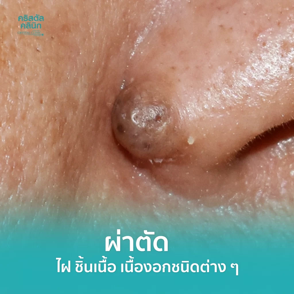 ผ่าตัดไฝ กำจัดไฝขี้แมลงวัน คริสตัลคลินิก มหาสารคาม