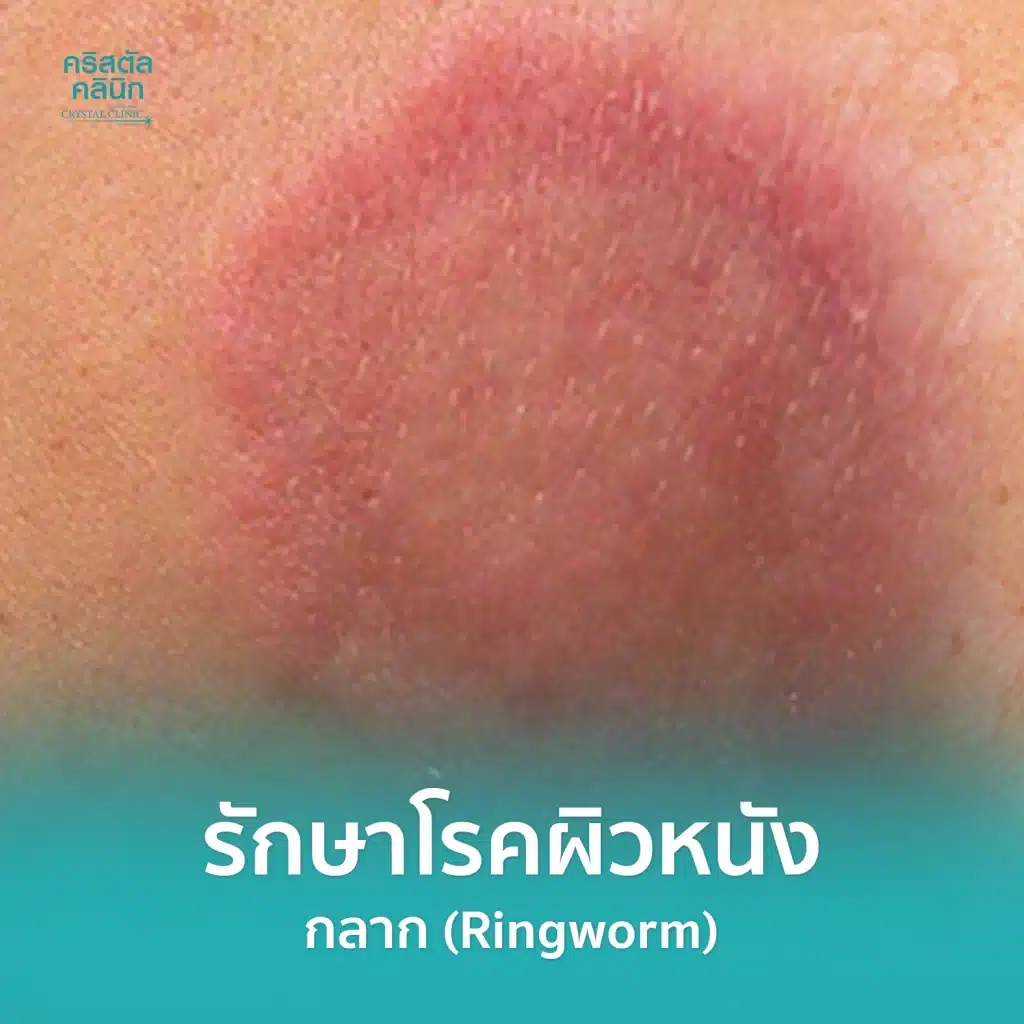 รักษากลาก (Ringworm) โรคผิวหนัง คริสตัลคลินิก มหาสารคาม