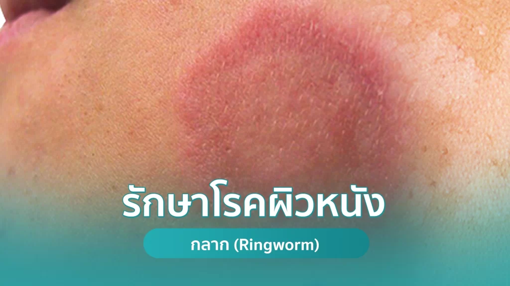 รักษากลาก (Ringworm) โรคผิวหนัง คริสตัลคลินิก มหาสารคาม รักษากลาก (Ringworm) โรคผิวหนัง คริสตัลคลินิก มหาสารคาม