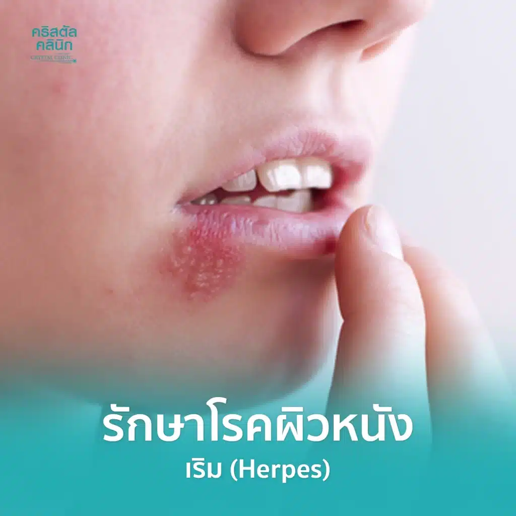 รักษาเริม (Herpes) โรคผิวหนัง คริสตัลคลินิก มหาสารคาม