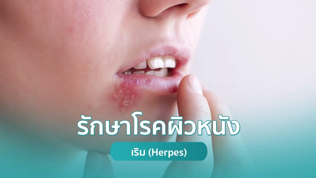 รักษาเริม (Herpes) โรคผิวหนัง คริสตัลคลินิก มหาสารคาม รักษาเริม (Herpes) โรคผิวหนัง คริสตัลคลินิก มหาสารคาม