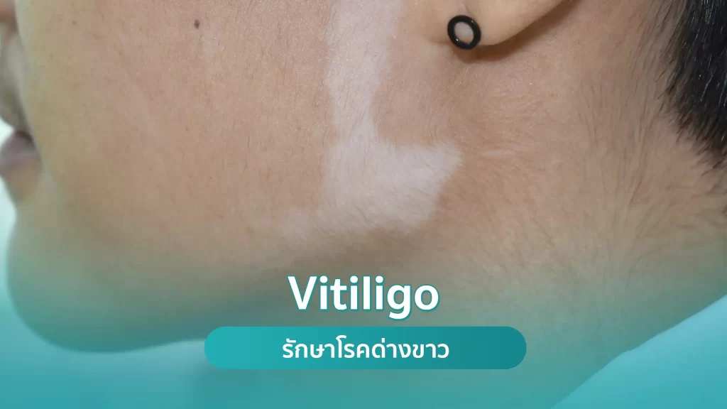 โรคด่าวขาว Vitiligo คริสตัลคลินิก มหาสารคาม