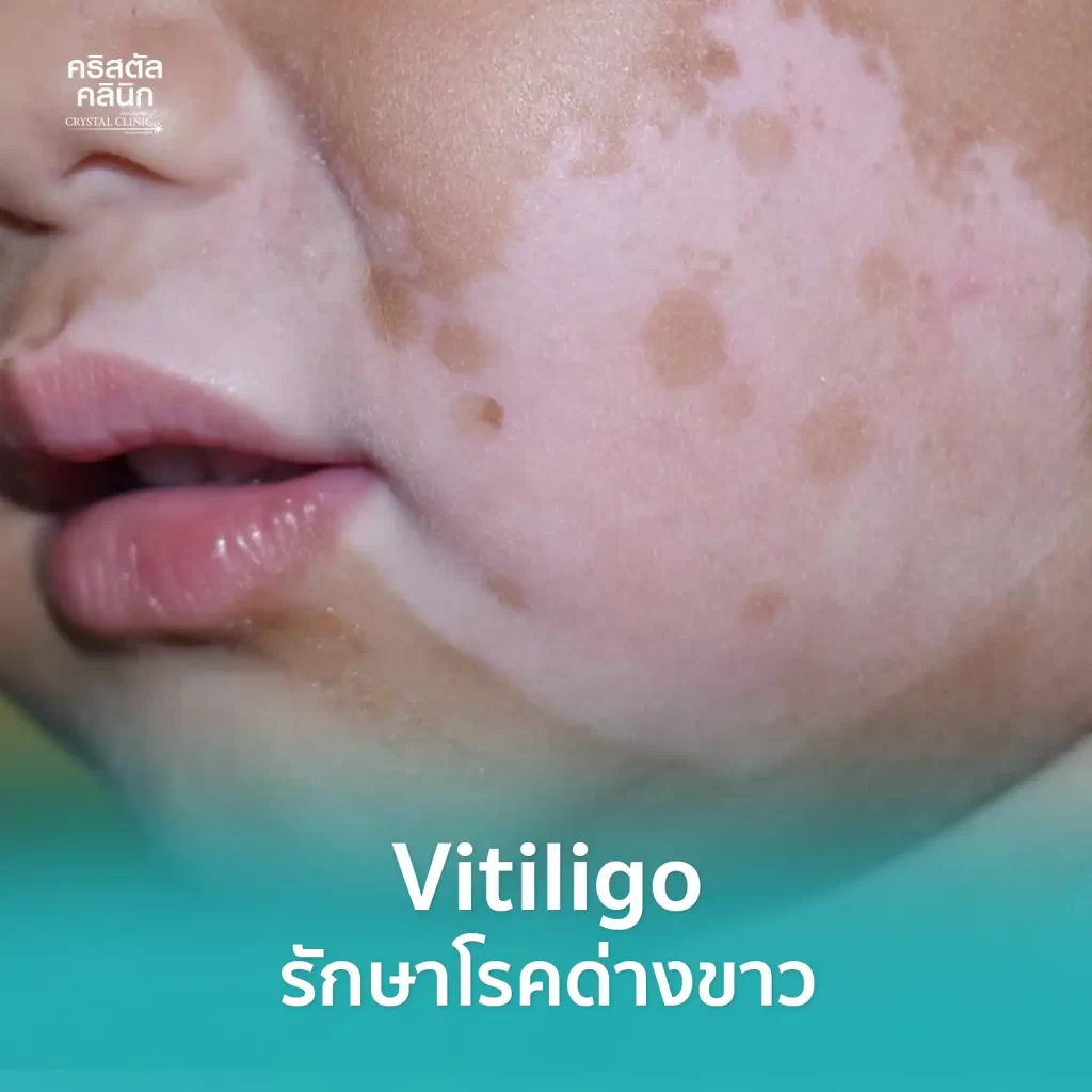 รักษาโรคด่างขาว คริสตัลคลินิก มหาสารคาม