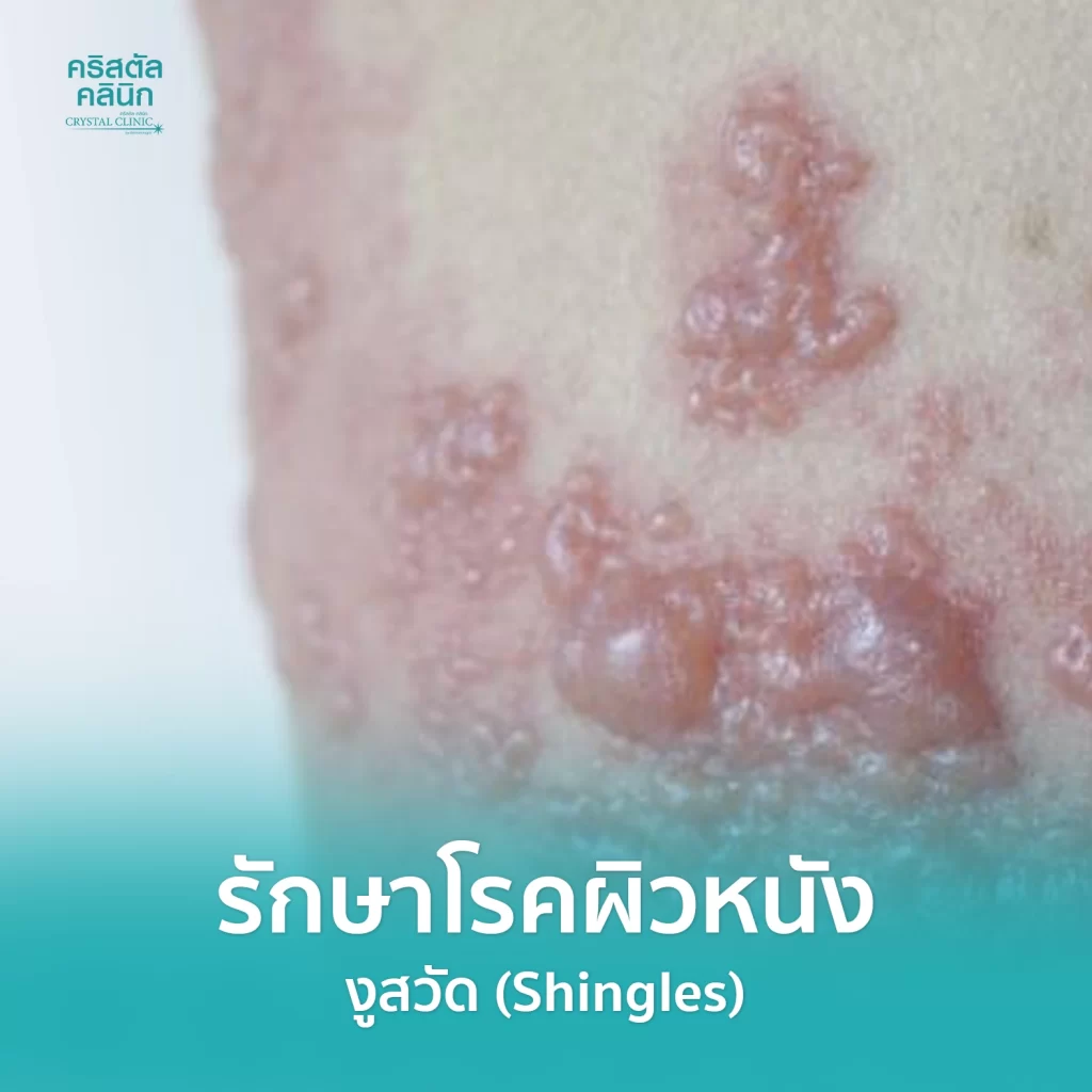 รักษาโรคผิวหนัง รักษางูสวัด (Shingles) คริสตัลคลินิก