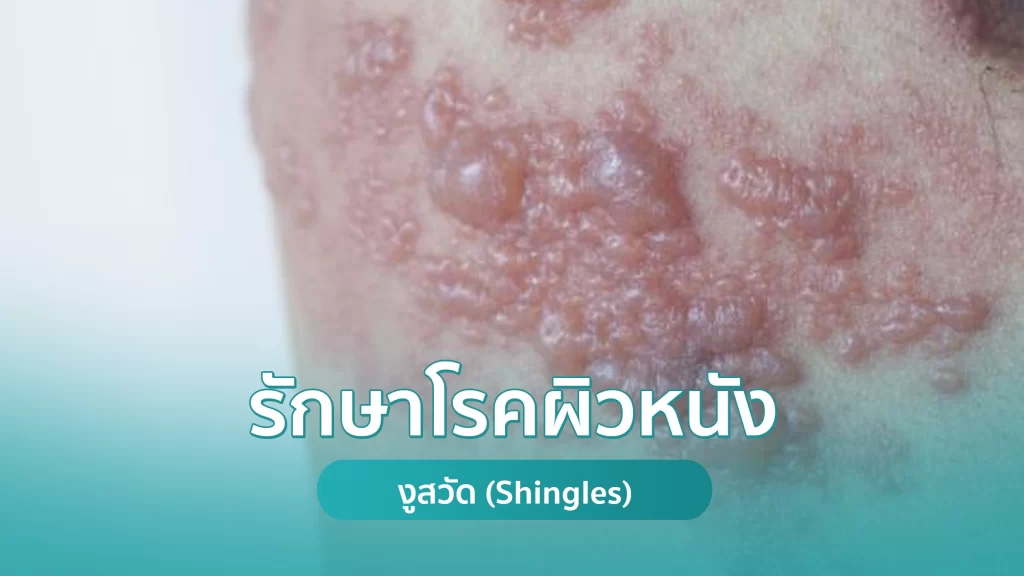 รักษาโรคผิวหนัง รักษางูสวัด (Shingles) คริสตัลคลินิก รักษาโรคผิวหนัง รักษางูสวัด (Shingles) คริสตัลคลินิก