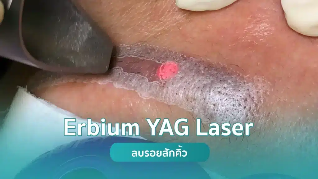 Erbium YAG Laser ลบรอยสักคิ้ว คริสตัลคลินิก มหาสารคาม ลบรอยสักคิ้ว (Erbium YAG Laser) คริสตัลคลินิก