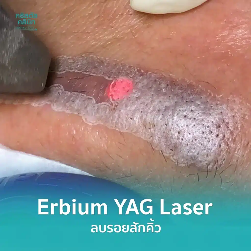 ลบรอยสักคิ้ว (Erbium YAG Laser) คริสตัลคลินิก