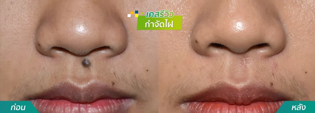 เคสรีวิวผ่าตัดไฝที่จมูก คริสตัลคลินิก มหาสารคาม