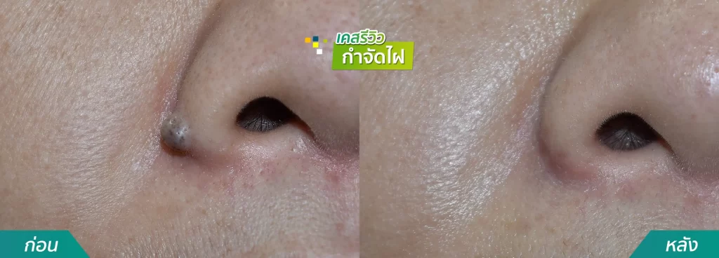 เคสรีวิวผ่าตัดไฝที่ปีกจมูก คริสตัลคลินิก มหาสารคาม
