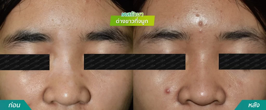 เคสรีวิวรักษาโรคด่าวขาวที่จมูก คริสตัลคลินิก มหาสารคาม
