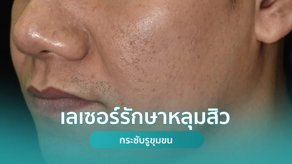 เลเซอร์รักษาหลุมสิว กระชับรูขุมขน ึคริสตัลคลินิก มหาสารคาม เลเซอร์รักษาหลุมสิว กระชับรูขุมขน ึคริสตัลคลินิก มหาสารคาม