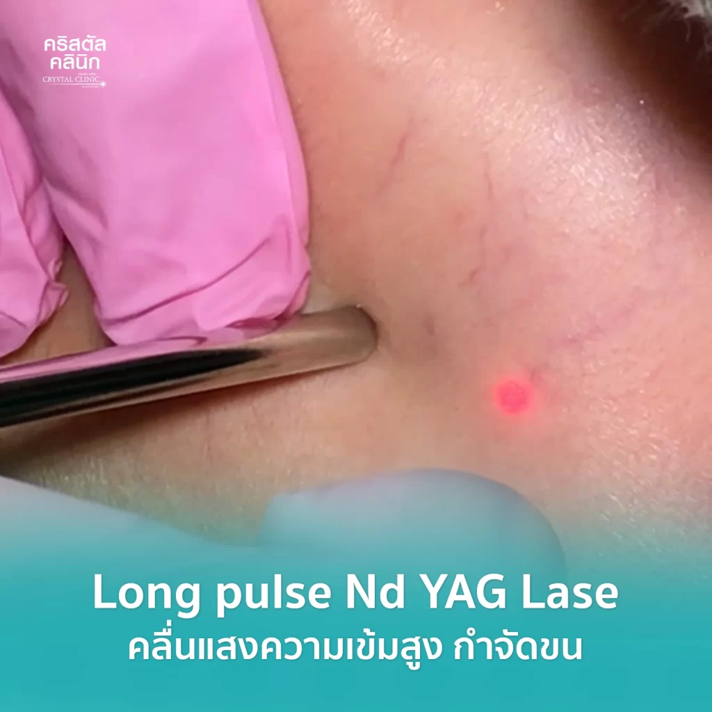 เลเซอร์รักษาเส้นเลือดฝอย รักษาเส้นเลือดขอด (Long pluse Nd YAG) คริสตัลคลินิก มหาสารคาม