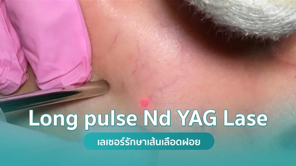 Long pulse Nd YAG Laser รักษาเส้นเลือดฝอย เส้นเลือดขอด คริสตัลคลินิก มหาสารคาม เลเซอร์รักษาเส้นเลือดฝอย รักษาเส้นเลือดขอด (Long pluse Nd YAG) คริสตัลคลินิก มหาสารคาม