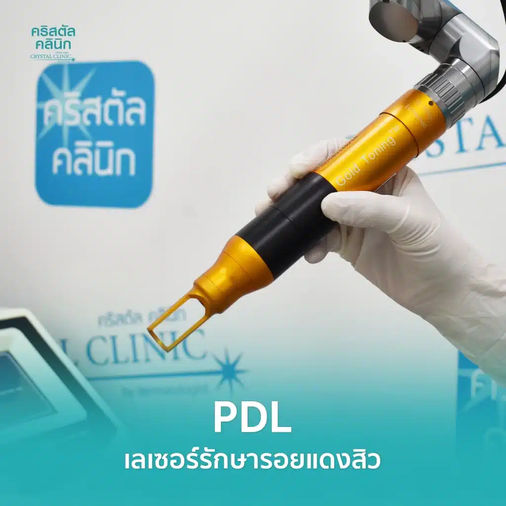 PDL Laser รักษารอยแดง รอยแดงสิว ด้วยเลเซอร์ คริสตัลคลินิก
