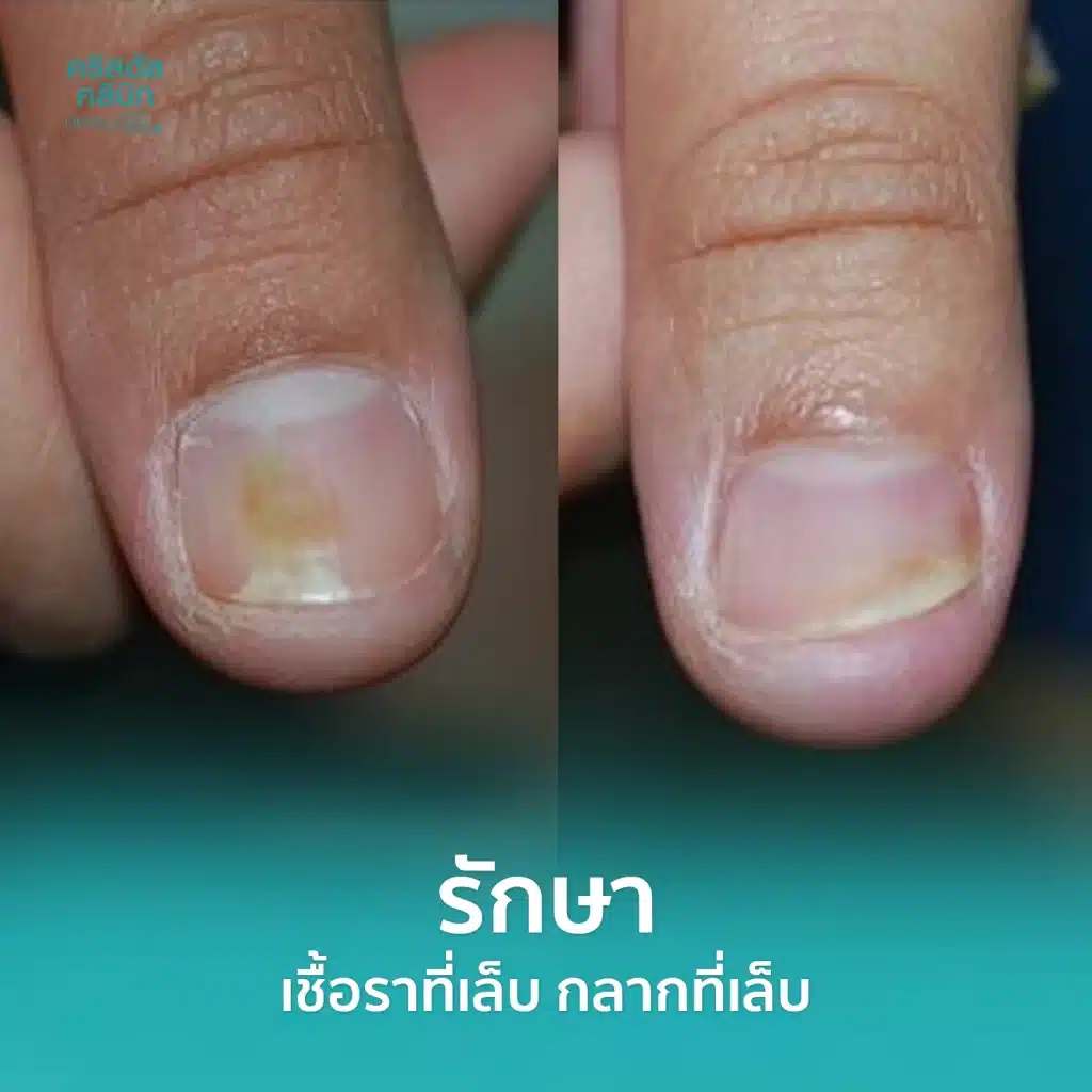 รักษาเชื้อราที่เล็บ กลากที่เล็บ