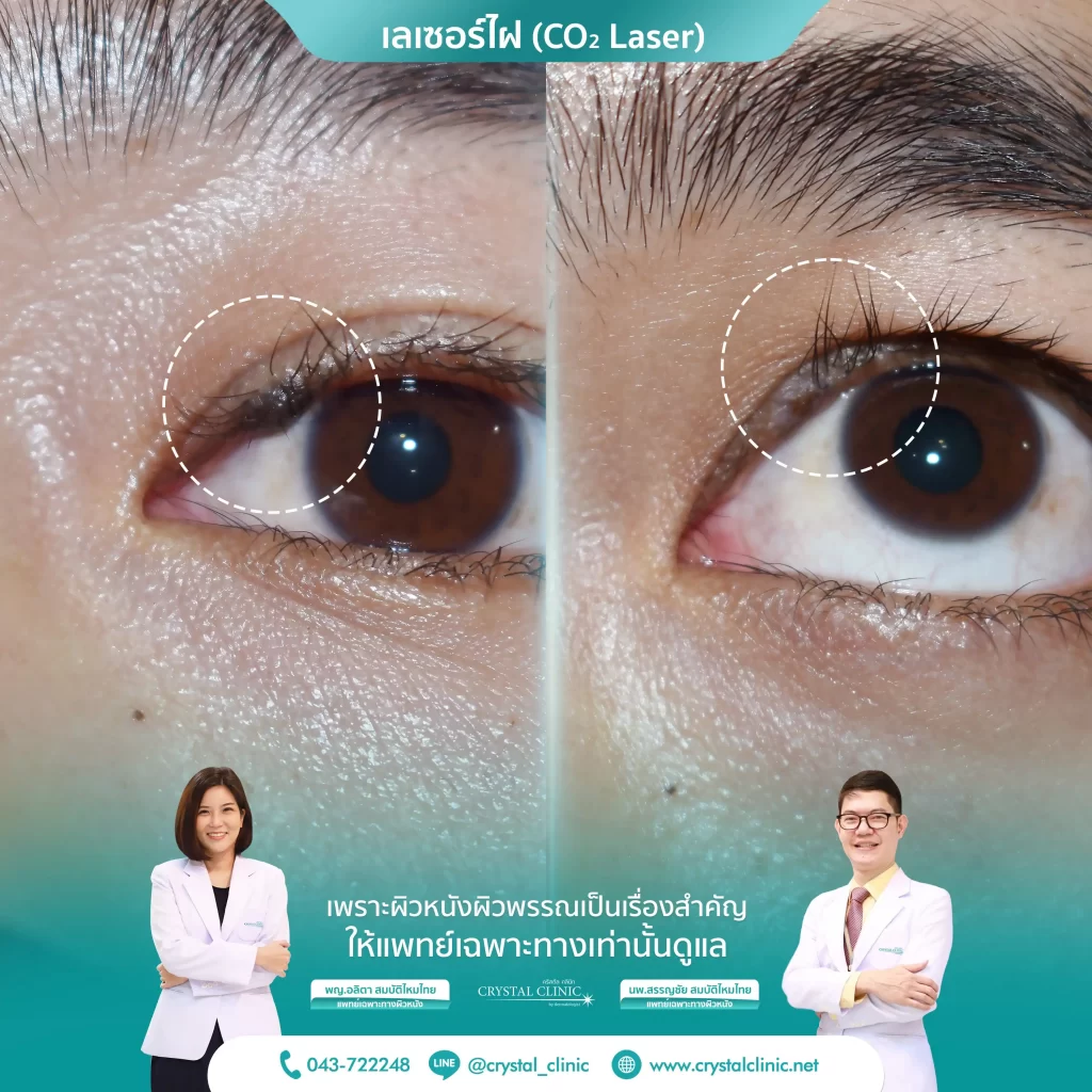 เลเซอร์ไฝเปลือกตา คริสตัลคลินิก มหาสารคาม เลเซอร์ไฝเปลือกตา คริสตัลคลินิก มหาสารคาม