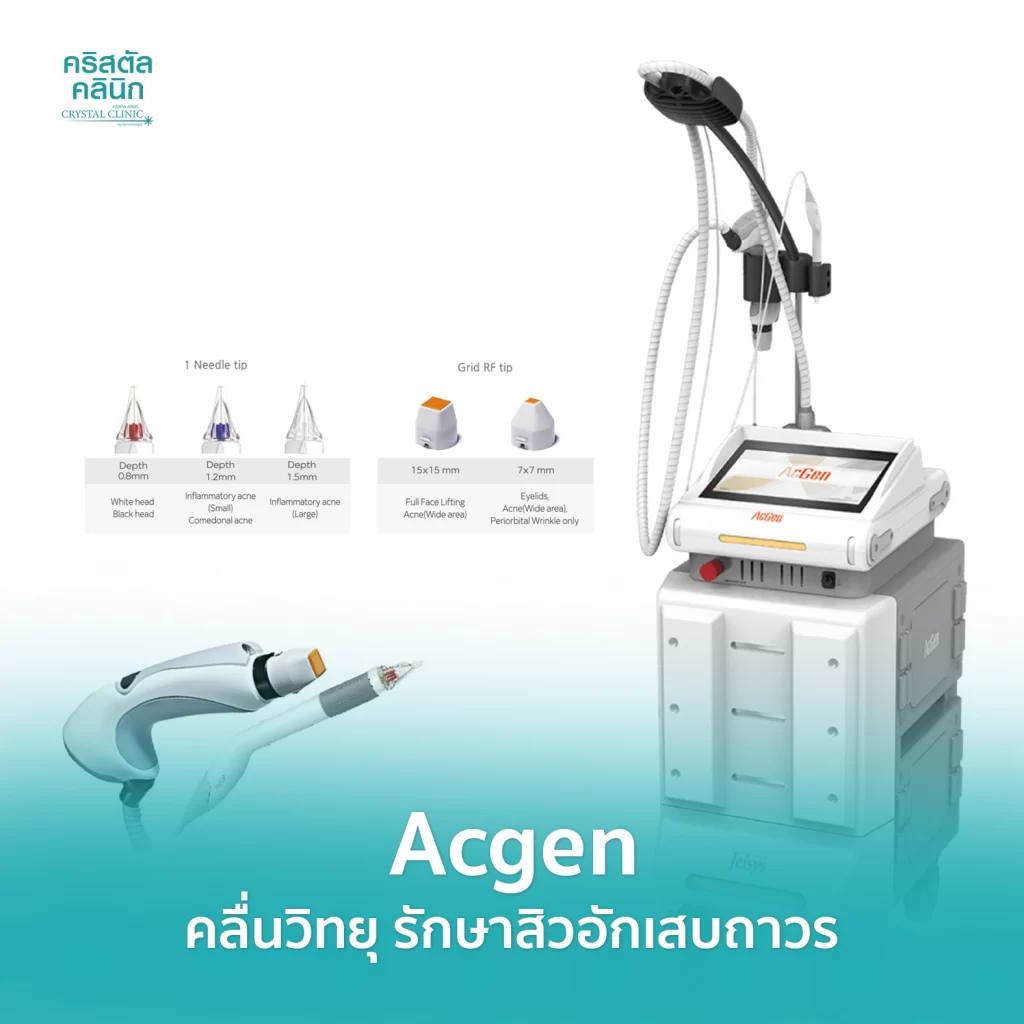 Acgen คลื่นวิทยุทำลายต่อมไขมัน รักษาสิวอักเสบถาวร