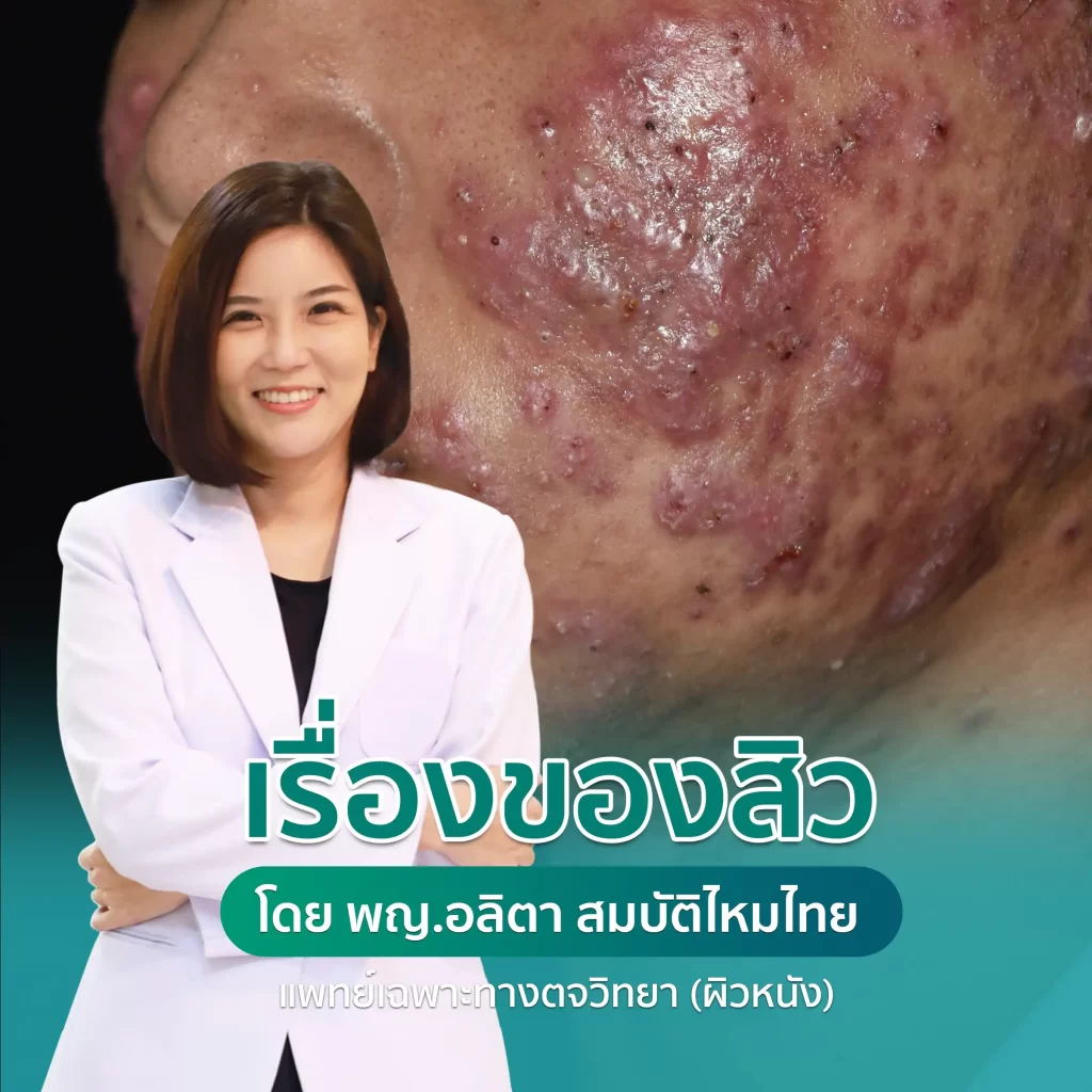 บทความเรื่องของสิว โดย พญ อลิตา สมบัติไหมไทย