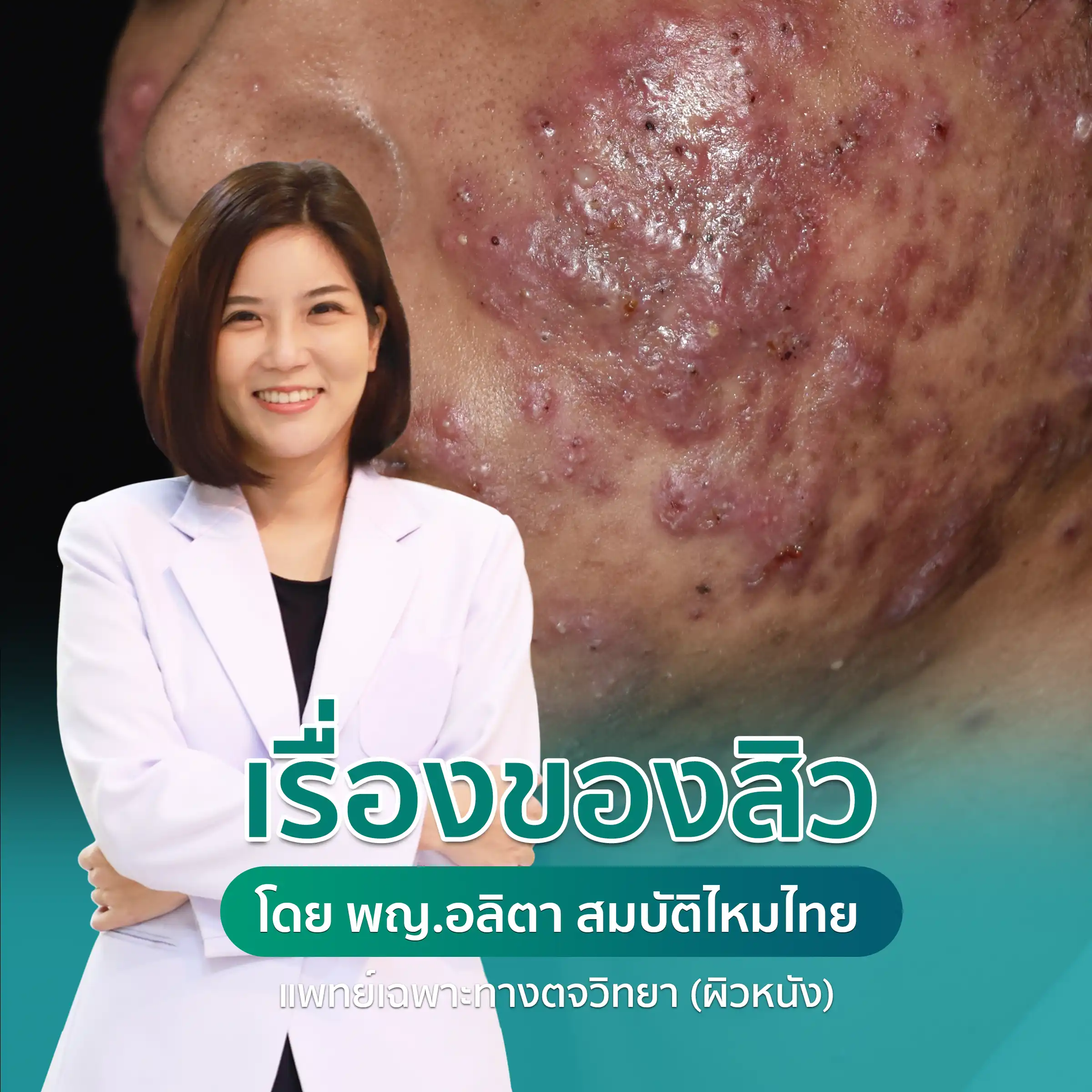 บทความเรื่องของสิว โดย พญ อลิตา สมบัติไหมไทย