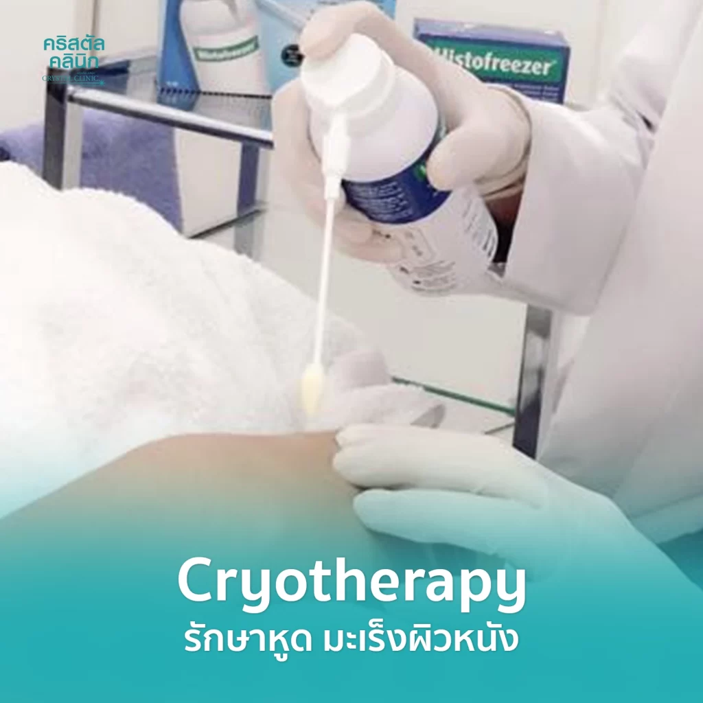 รักษาหูด หูดหงอนไก่ มะเร็งผิวหนังชนิดเริ่มแรก (Liquid Nitrogen Cryotherapy)