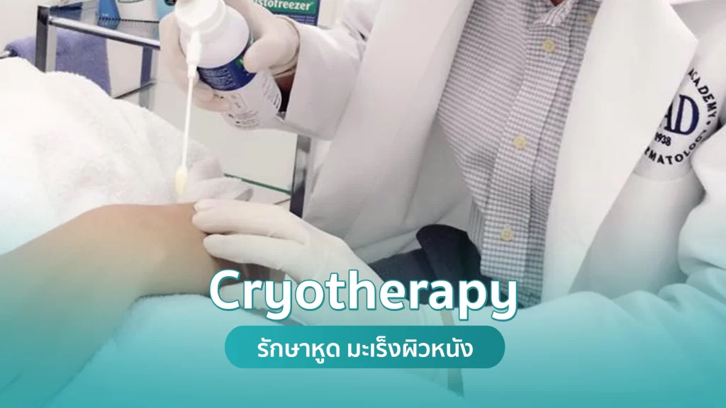 รักษาหูด หูดหงอนไก่ มะเร็งผิวหนังชนิดเริ่มแรก (Liquid Nitrogen Cryotherapy) คริสตัลคลินิก มหาสารคาม