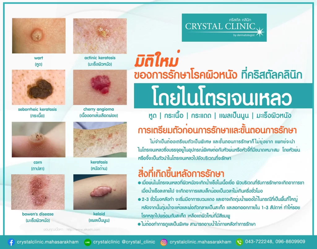 รักษาหูด หูดหงอนไก่ มะเร็งผิวหนังชนิดเริ่มแรก (Liquid Nitrogen Cryotherapy) คริสตัลคลินิก มหาสารคาม