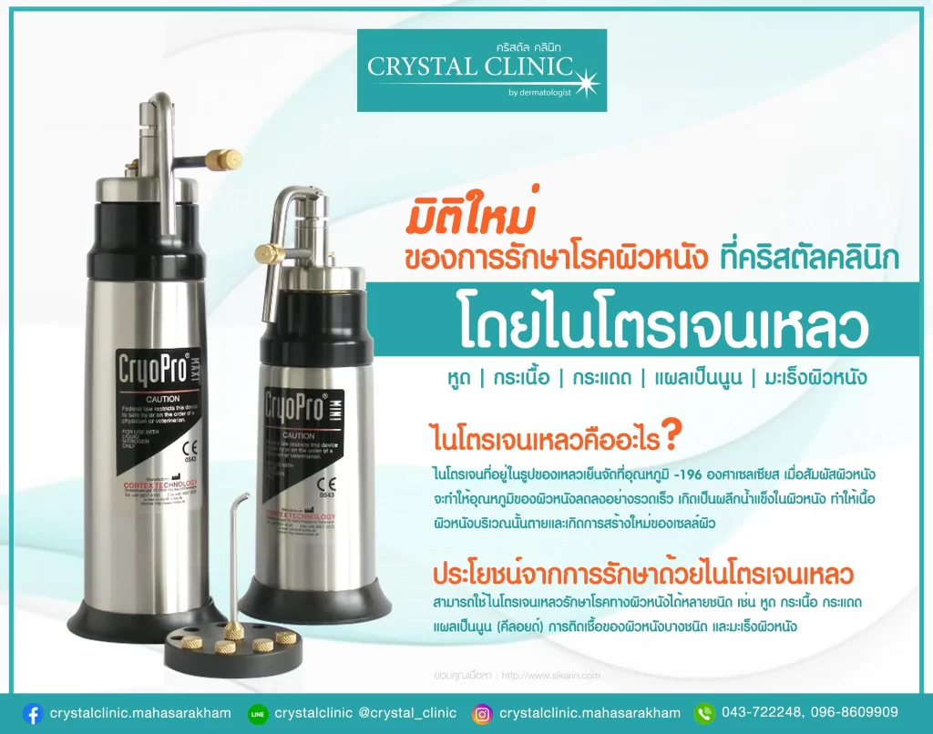 รักษาหูด หูดหงอนไก่ มะเร็งผิวหนังชนิดเริ่มแรก (Liquid Nitrogen Cryotherapy) คริสตัลคลินิก มหาสารคาม