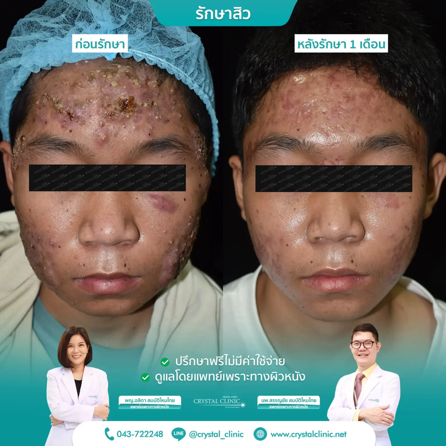 Acne 7